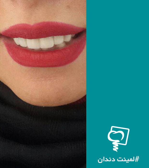 لمینت دندان