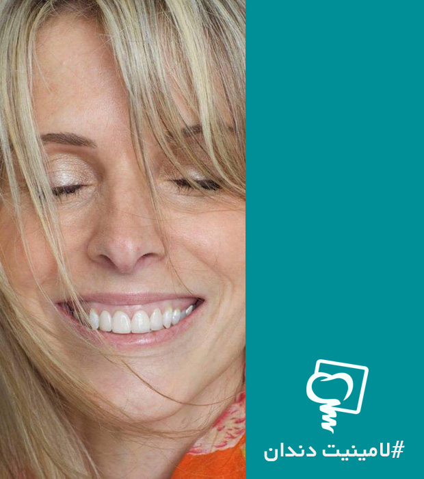 لمینت دندان