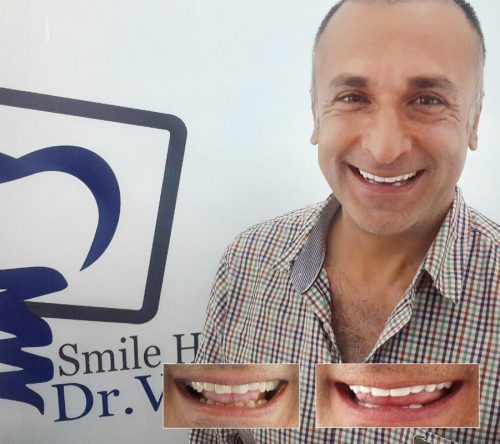 کامپوزیت ونیر