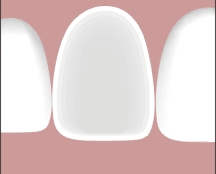 لمینت دندان