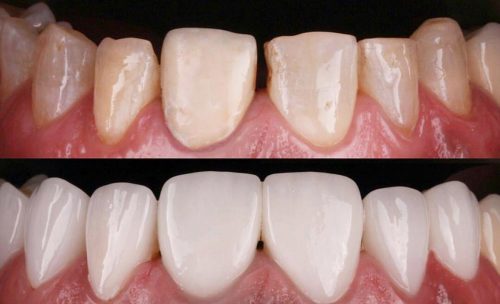 لمینت دندان