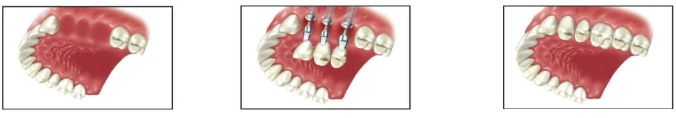 بهترین زمان برای کاشت ایمپلنت 