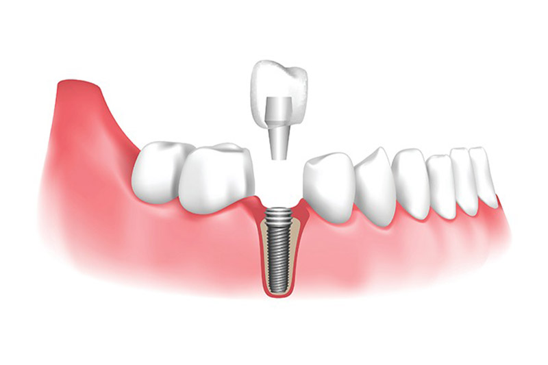 روش-های-کاشت-دندان