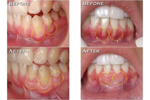 مراقبت‌های-بعد-از-پیوند-لثه