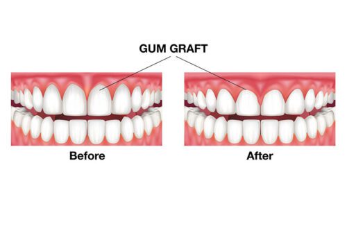 مزایای-پیوند-لثه
