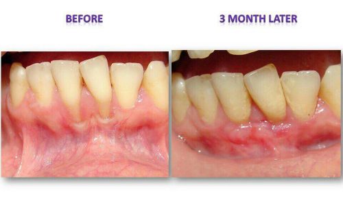 جراحی پیوند لثه