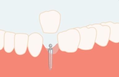 مینی ایمپلنت دندان