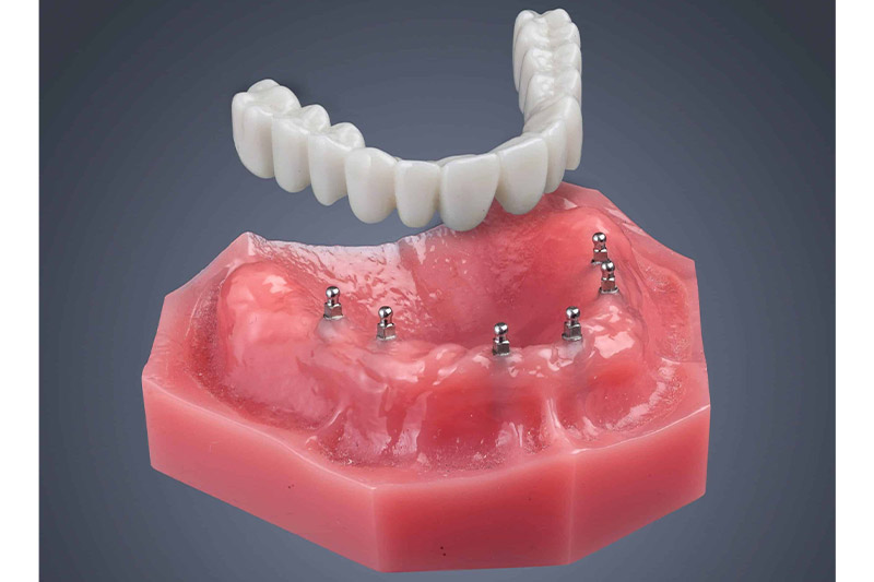 مینی-ایمپلنت-دندان-چیست