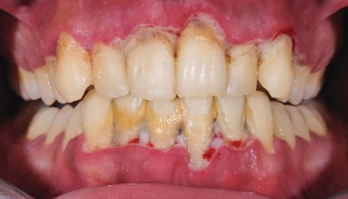 عکس عفونت لثه