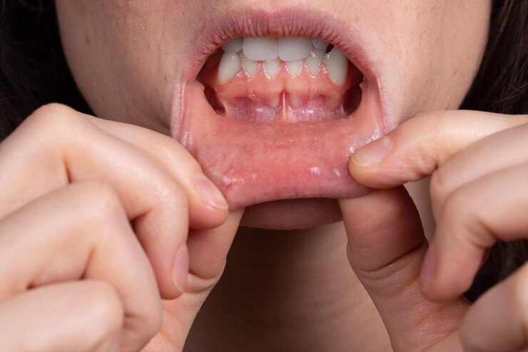 علل چرک لثه