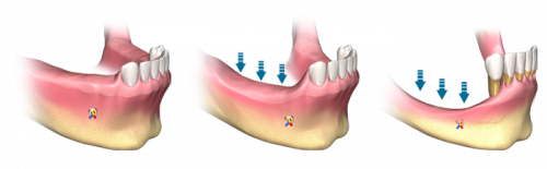 تحلیل استخوان فک ناشی از افتادن چند دندان 