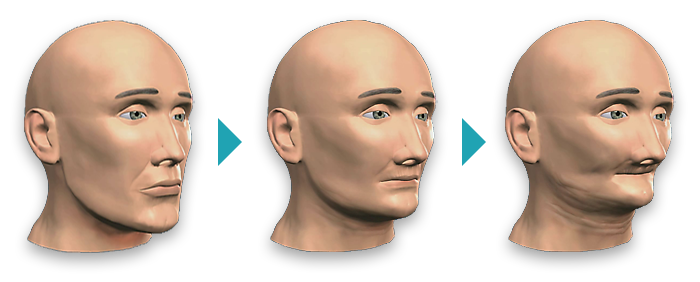 تحلیل استخوان فک کل صورت