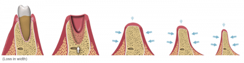 عکس تحلیل استخوان فک به صورت جانبی