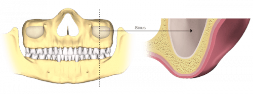 تحلیل استخوان فک ناشی از افتادن چند دندان