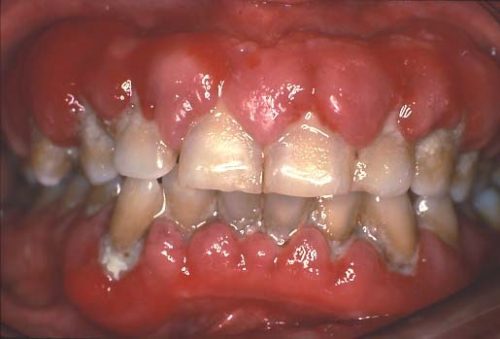 عکس ورم لثه