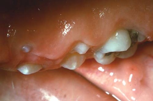 علت باد كردن لثه دندان عقل