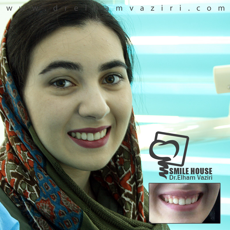 اصلاح لبخند لثه ای