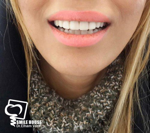 عکس کامپوزیت دندان