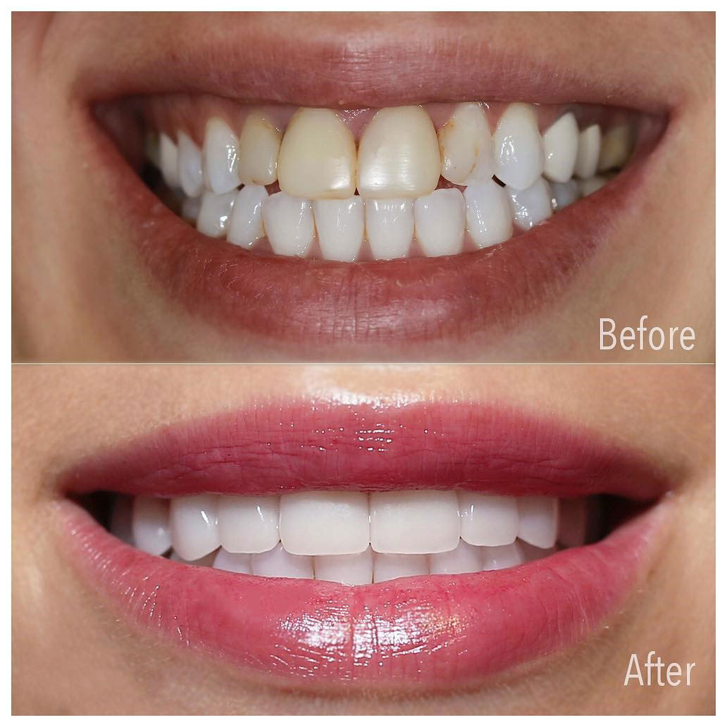 قبل و بعد لمینت دندان