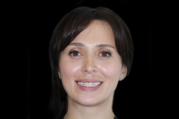 قبل از لمینت دندان