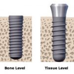 ایمپلنت bone level