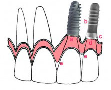 شکل ایمپلنت در لثه
