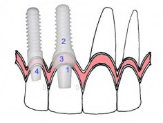 انواع جنس ایمپلنت