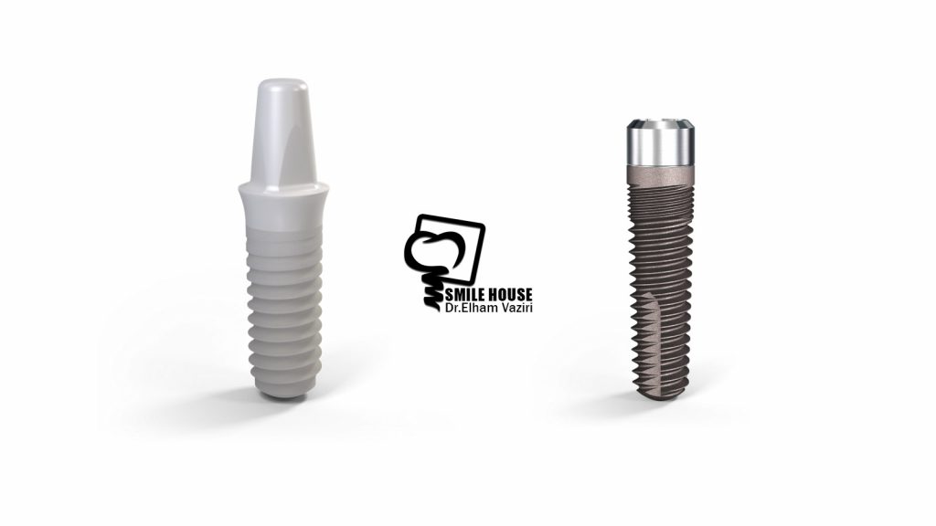 ایمپلنت زیرکونیا