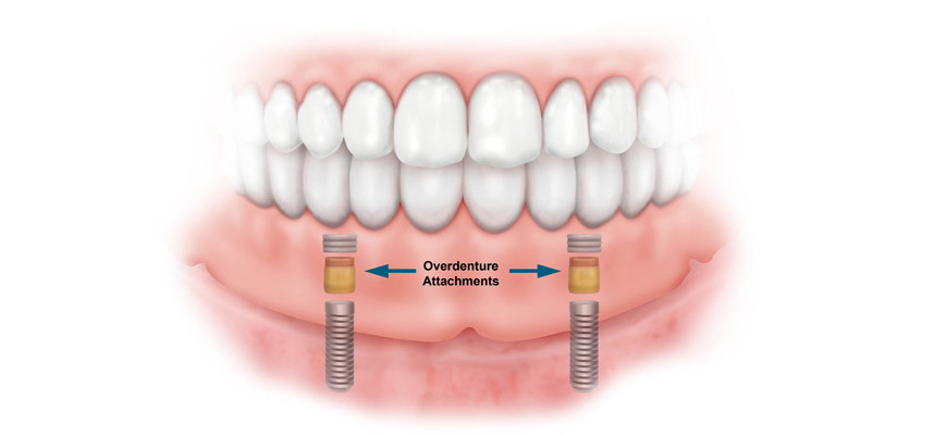 بهترین راه حل برای شل شدن دندان مصنوعی