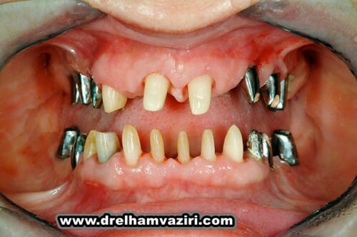 ایمپلنت فوری دندان