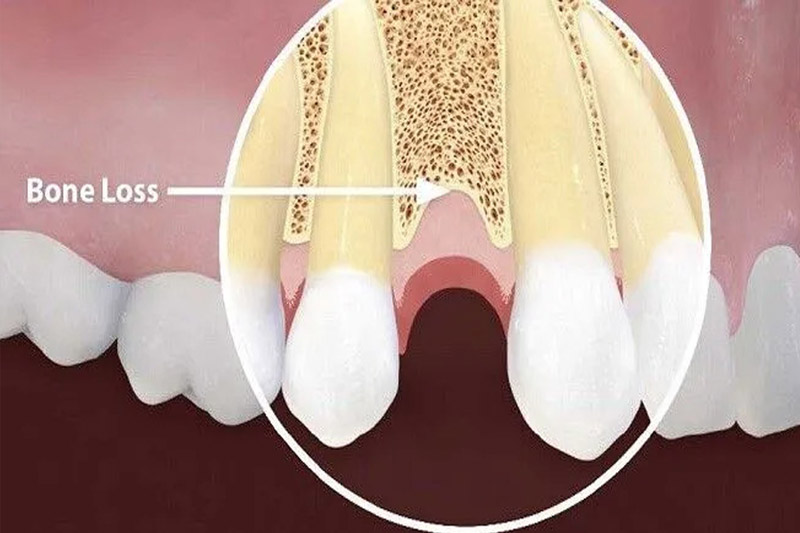 عوامل-مؤثر-بر-موفقیت-کاشت-ایمپلنت-در-افراد-مبتلا-به-پوکی-استخوان