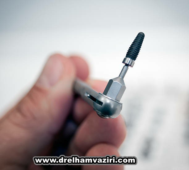 آرام بخشی برای ایمپلنت دندان