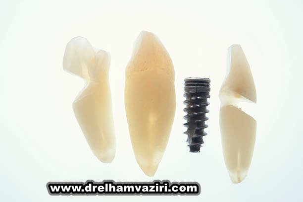 کاشت ایمپلنت دندان با بیهوشی