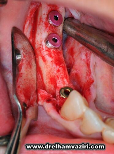 درمان لق شدن دندان مصنوعی