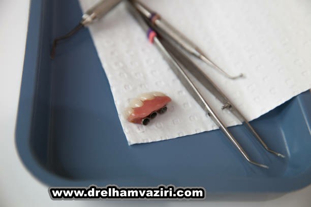 پوکی استخوان و ایمپلنت دندان