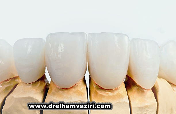 آیا دیابت می تواند ایمپلنت دندان را دشوار کند