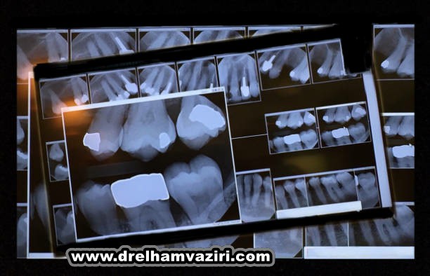 آیا دیابت می تواند ایمپلنت دندان را دشوار کند