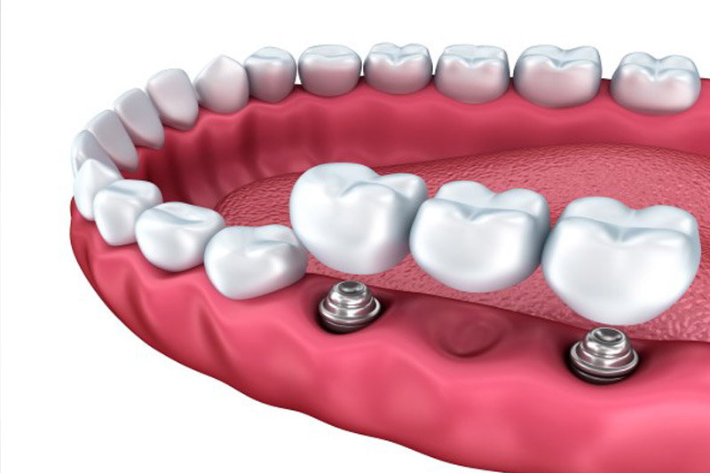 مواد-سازنده-بریج