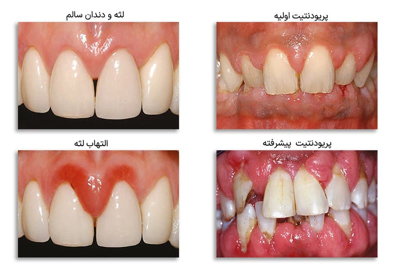 عکس-بیماری-پریودنتال