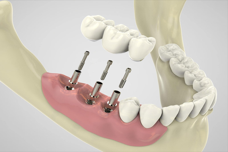 کاشت-ایمپلنت-های-دندانی-برای-چه-افرادی-امکان-پذیر-نیست