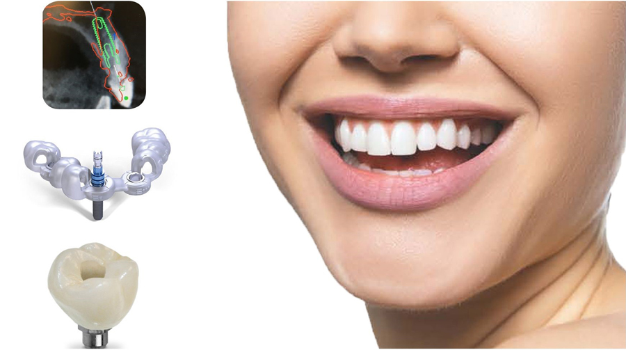 ایمپلنت دیجیتال چیست