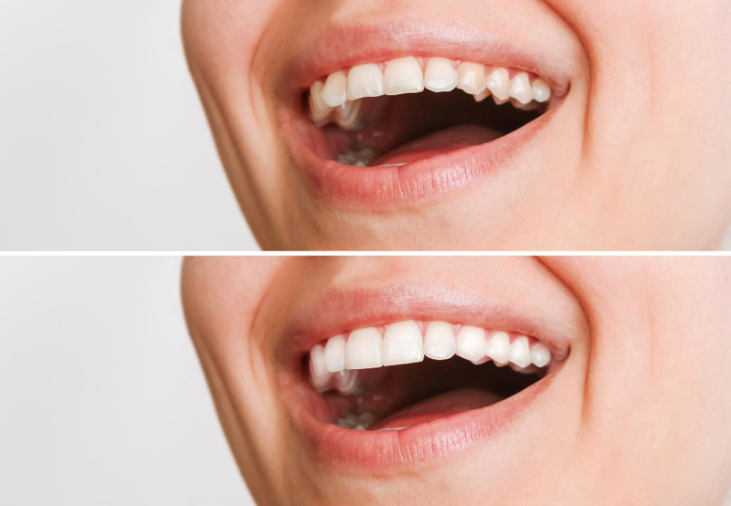 بهترین لمینت دندان