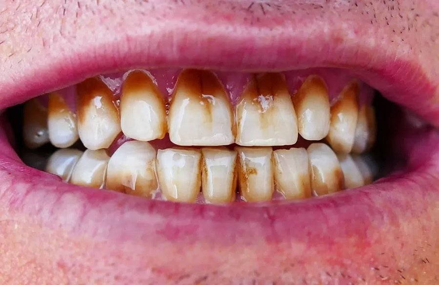 بیماری پریودنتال چیست