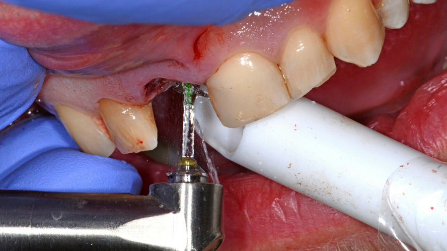 ایمپلنتد دیجیتال یا پانچ