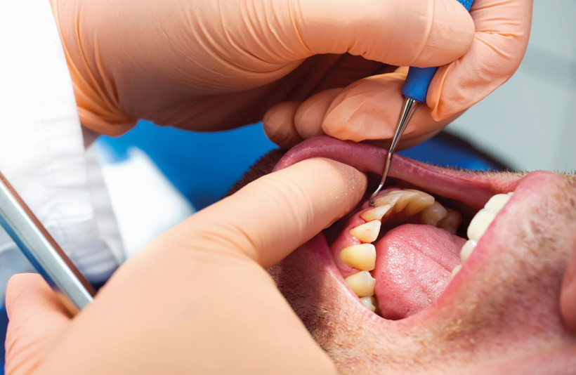  علت بیماری پریودنتال