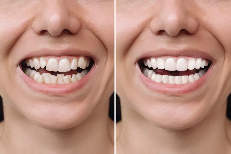 طول-عمر-ونیر-کامپوزیت