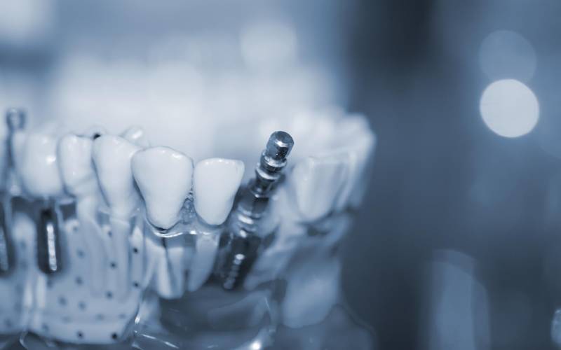 ایمپلنت دندان