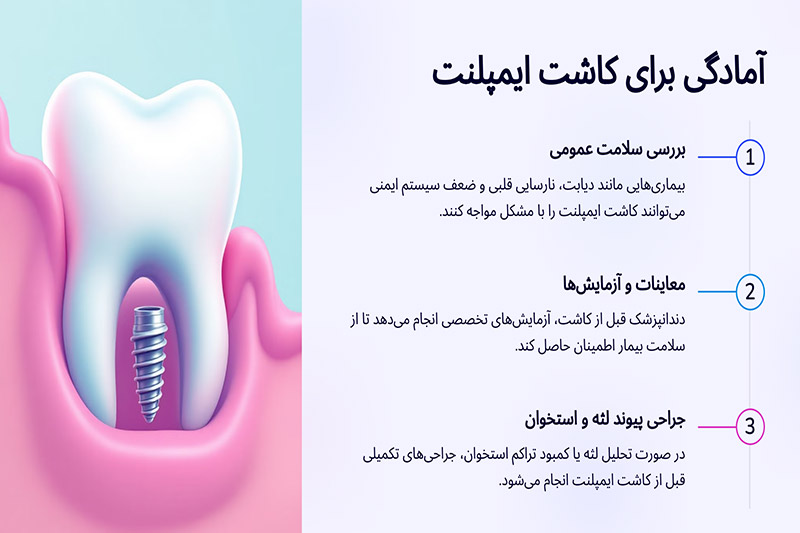 آمادگی-کاشت-ایمپلنت