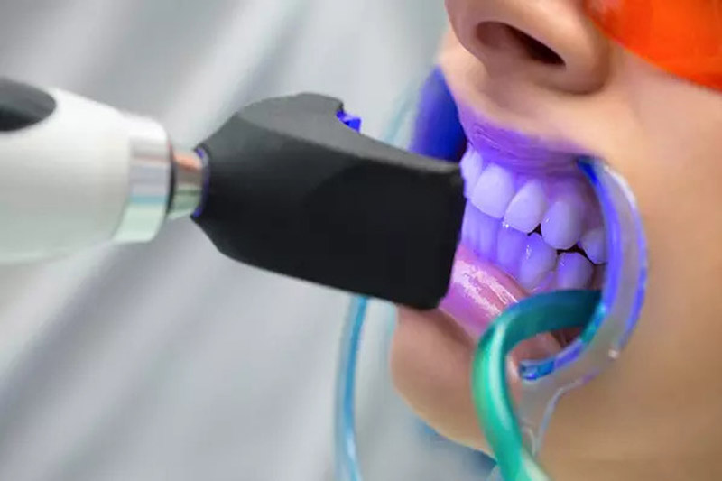 بلیچینگ-دندان-چیست