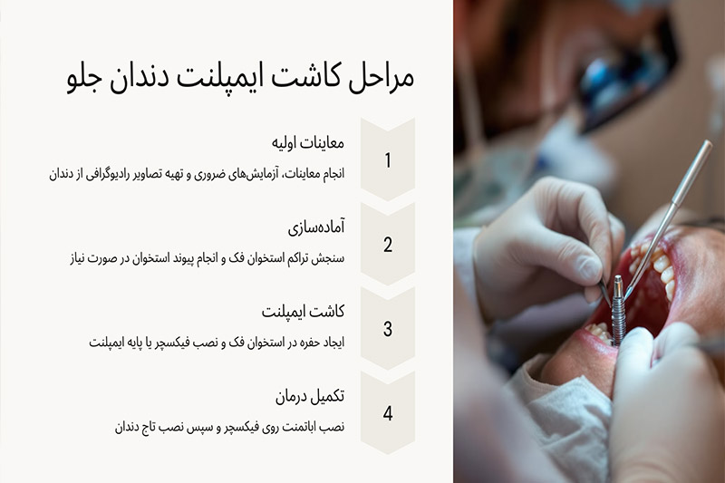 مراحل-کاشت-ایمپلنت-دندان-جلو-در-یک-نگاه